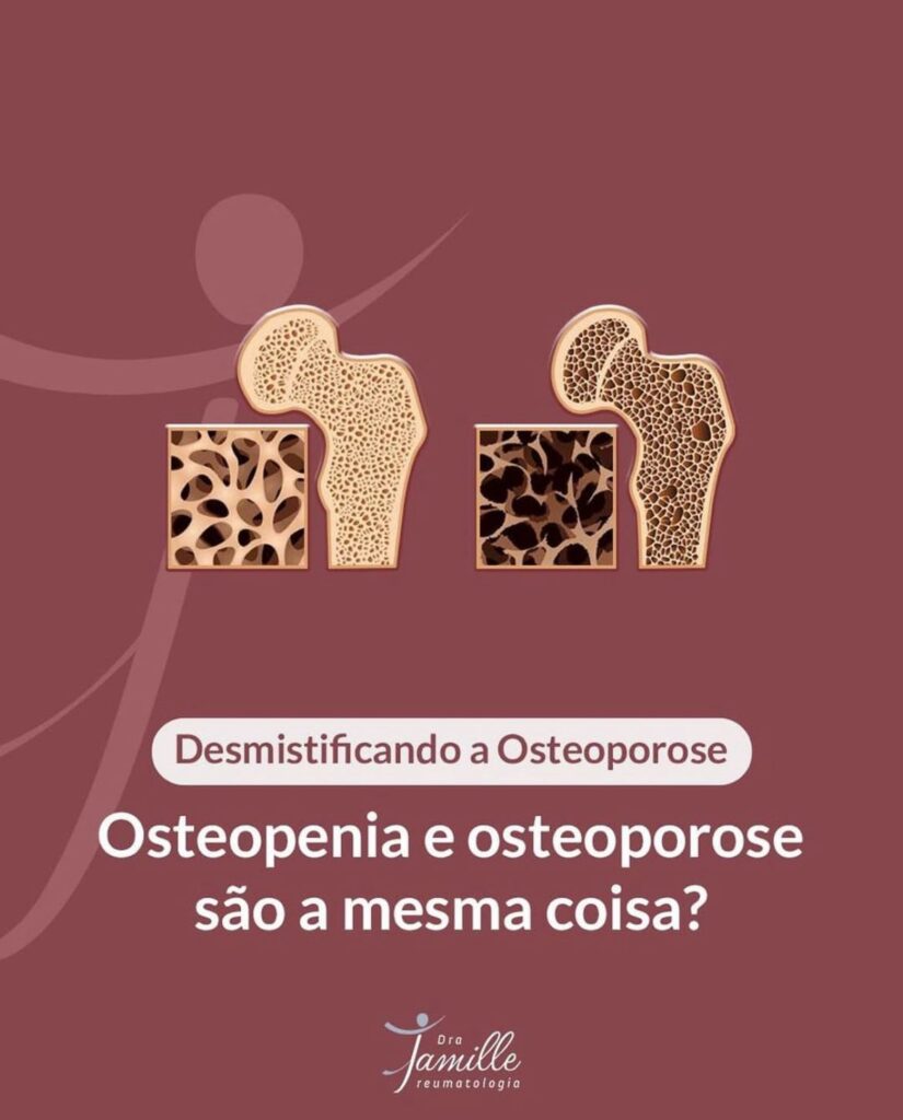 Osteoporose e Osteopenia são a mesma coisa?